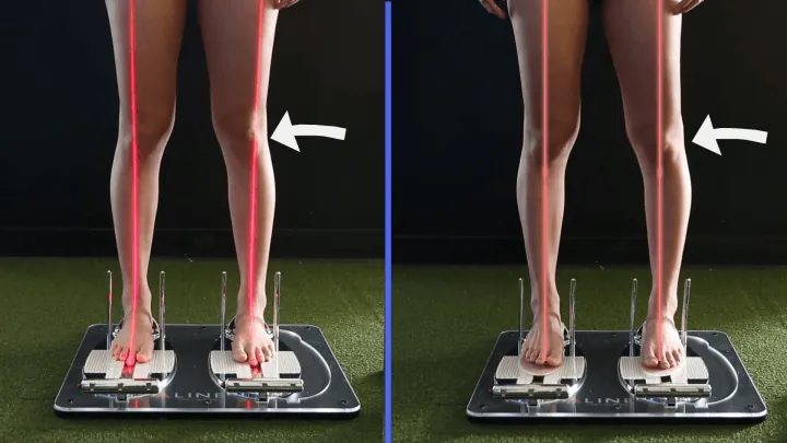 Aline Insoles before and after leg and knee alignment comparison